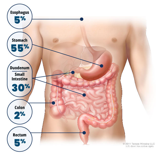 An anatomic illustration showing the different organ sites where and how often GIST develops.