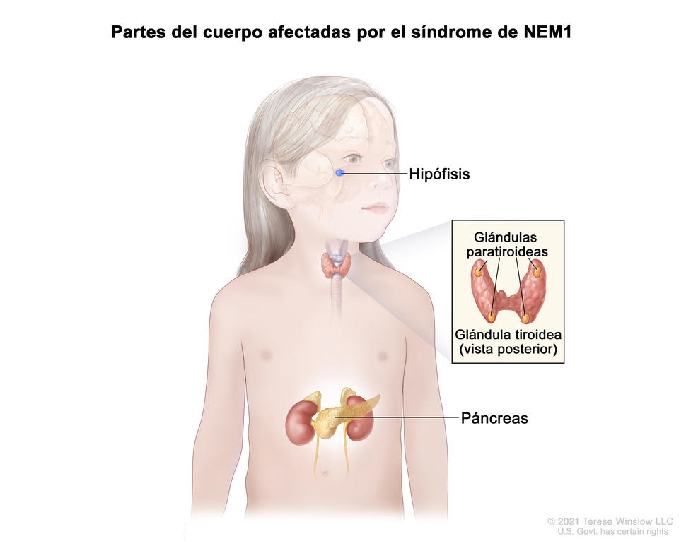 Dibujo del cuerpo de una niña donde se observan partes del cuerpo que afecta el síndrome de NEM1, como la hipófisis, las glándulas paratiroideas y el páncreas. En un recuadro se muestra una vista posterior y agrandada de la glándula tiroidea y se señalan las cuatro glándulas paratiroideas del tamaño de una arveja.