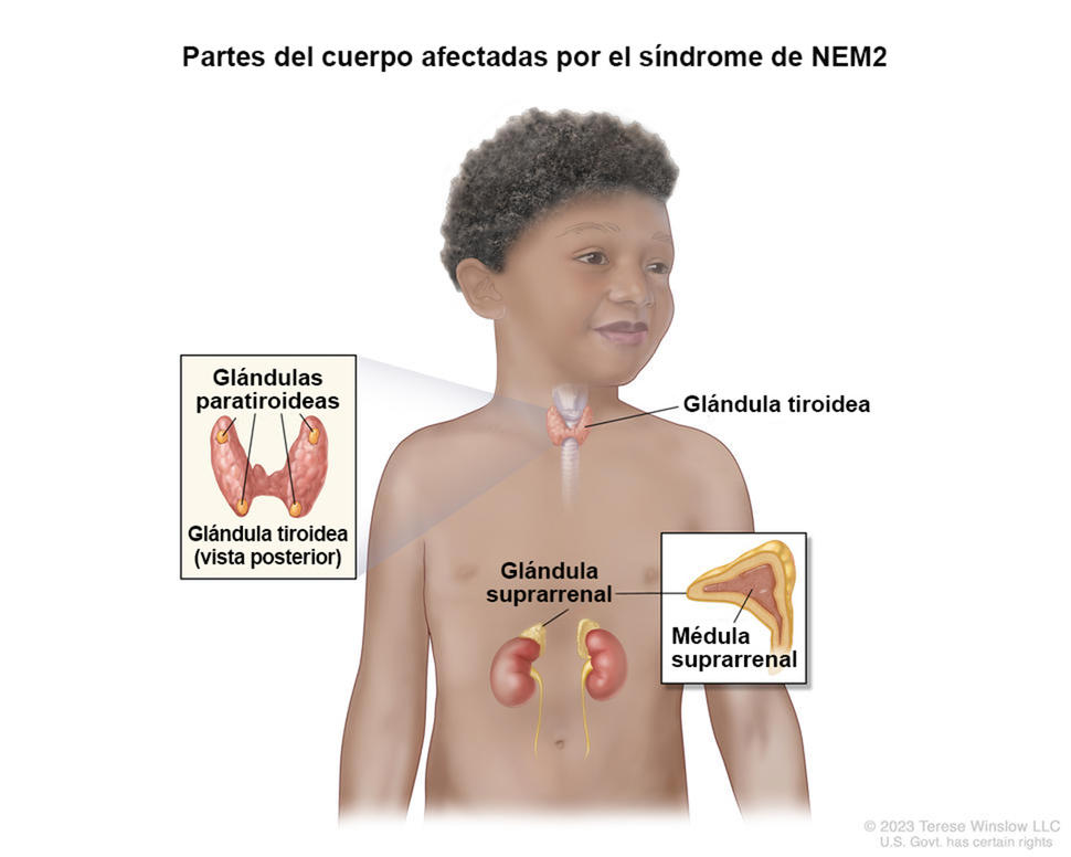 Dibujo del cuerpo de una niña donde se observan partes del cuerpo que afecta el síndrome de NEM2, como la glándula tiroidea, las glándulas paratiroideas, la glándula suprarrenal y la médula suprarrenal. En un recuadro se muestra una vista posterior y agrandada de la glándula tiroidea y se señalan las cuatro glándulas paratiroideas del tamaño de una arveja.