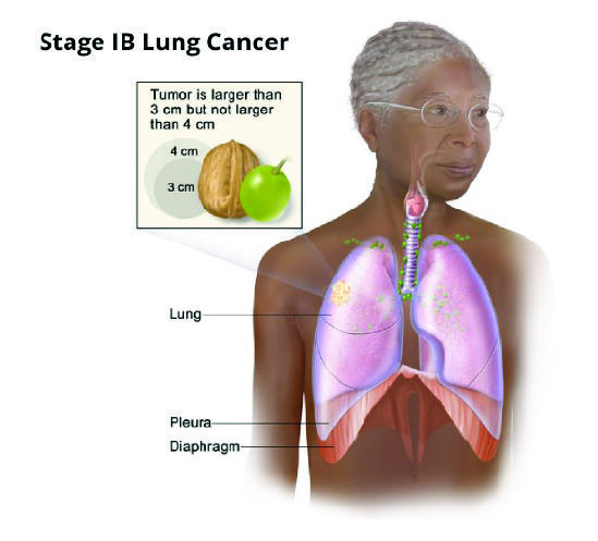 An illustration of stage 1B lung cancer