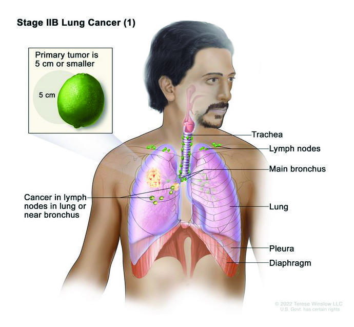 An anatomic illustration of stage 2b nonsmall cell lung cancer