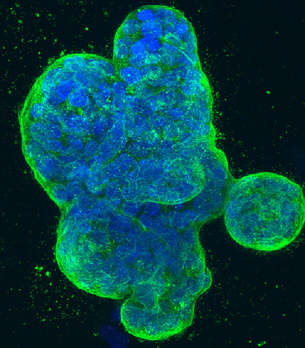 Three-dimensional culture of human breast cancer cells, with DNA stained blue and a protein in the cell surface membrane stained green. 