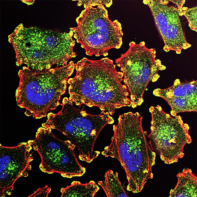 Podosomes are shown in melanoma cells along with cell nuclei, actin, and an actin regulator.