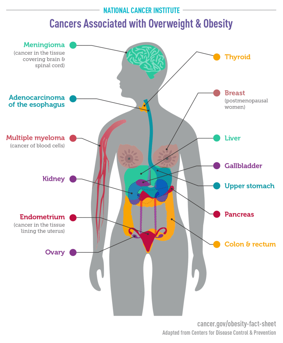 Diagram of the human body highlighting cancers associated with overweight & Obesity. The cancer types are: meningioma, adenocarcinoma of the esophagus, multiple myeloma, kidney, endometrium, ovary, thyroid, breast, liver, gallbladder, upper stomach, pancreas, and colon & rectum. 