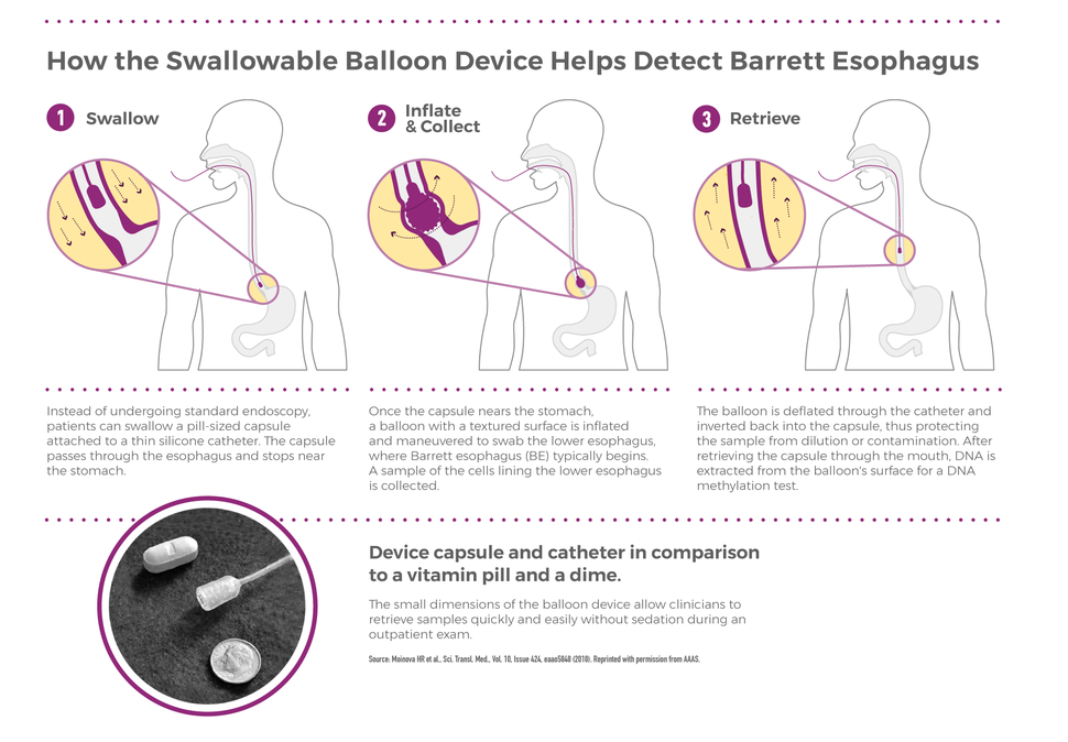 How a balloon device helps detect Barrett esophagus, it is swallowed, expands to collect a cell sample, and then is retrieved. 