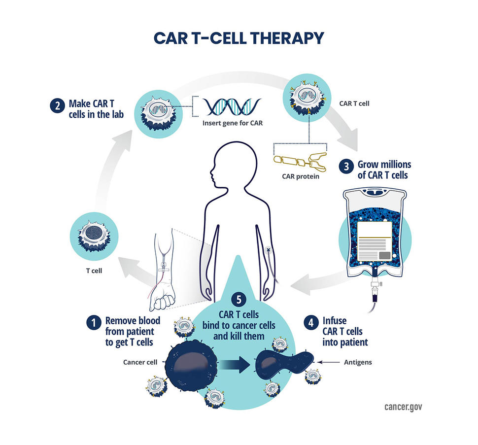 CAR T-cell therapy is a type of treatment in which a patient’s T cells are genetically engineered in the laboratory so they will bind to specific proteins (antigens) on cancer cells and kill them.