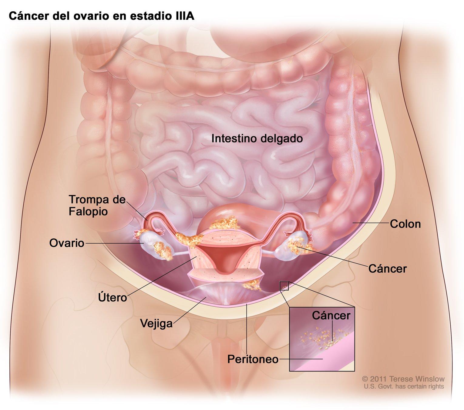 que es cancer hepatico y peritoneal)