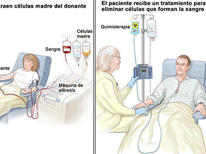 Trasplantes de células madre en el tratamiento del cáncer