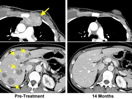 CT images show tumors in the chest wall and liver of a breast cancer patient. Images after immunotherapy treatment show the tumors are gone. 