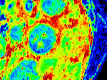 Follicular lymphoma cells stained purple (left) and a scanning acoustic microscopy image of follicular lymphoma cells in neon green, red, and blue (right)