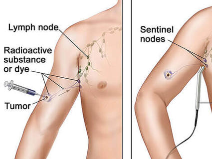 breast ectomy with sentinel node biopsy breast ectomy with sentinel node biopsy