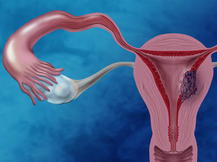 Illustration of the female reproductive system showing cancer cells in the endometrium.