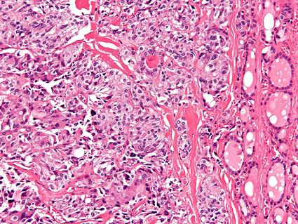 Photo taken through a microscope to show medullary thyroid carcinoma.