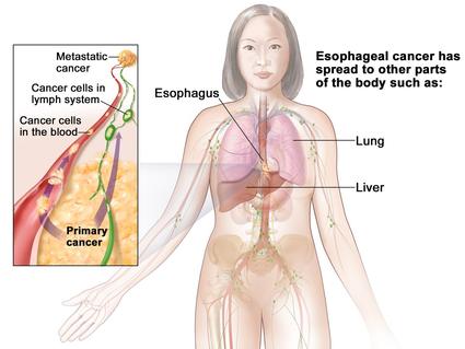 An anatomic illustration of stage IVB esophageal cancer.