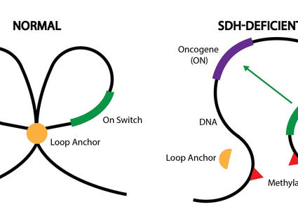 A graphic explaining epigenetic changes in normal cells and SDH-deficient GIST.