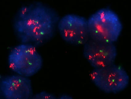 An image of breast cancer cells with strong HER2 amplification.