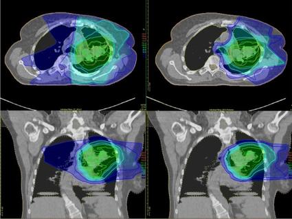 Scans of the chest after traditional radiation therapy and after proton therapy, which show how much surrounding tissue is affected by each type of therapy.