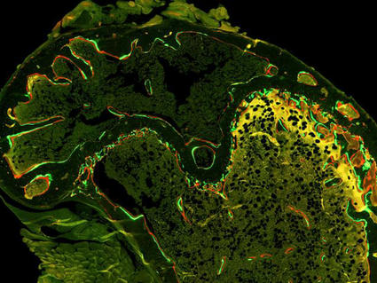 Bone scan showing bone loss after chemotherapy