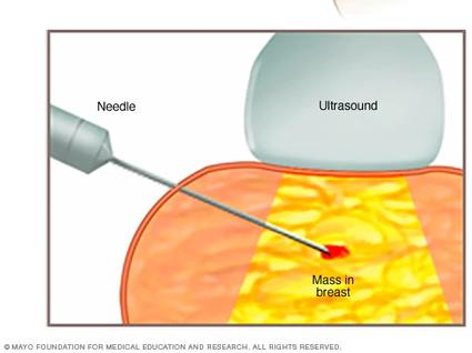 Illustration of a core needle biopsy of the breast.