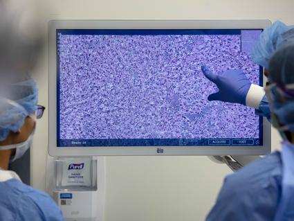 Image of surgical staff reviewing an image of a brain tumor biopsy.