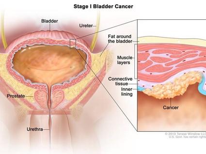 Medical illustration of stage 1 cancer invading the bladder