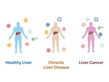 Virus particles surround three human figures with their livers highlighted. One figure has a healthy liver, one has chronic liver disease and one has liver cancer.