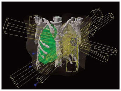 A case of stereotactic body radiation therapy (SBRT) for early stage lung cancer (T1N0M0)