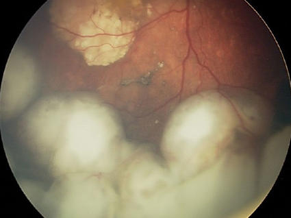 Fundoscopic exam revealing an intraocular retinoblastoma before treatment with intra-arterial chemotherapy