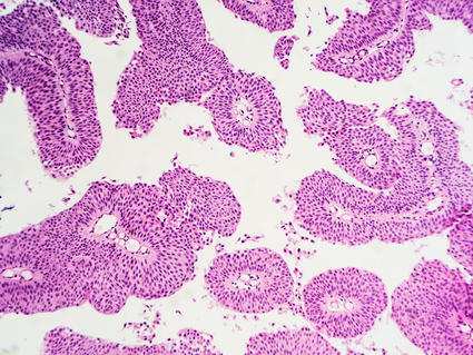 Microscopic section of a papillary urothelial (transitional cell) carcinoma, showing characteristic papillary structures with fibrovascular cores.