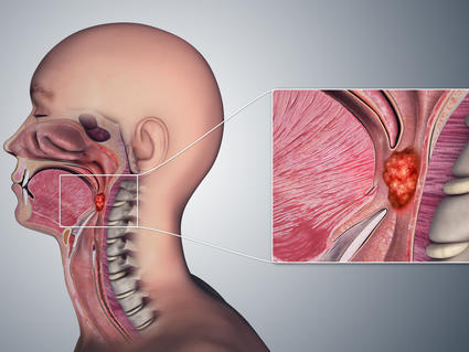 Anatomical illustration of a tumor in the oropharynx of a male.