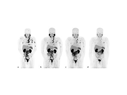 Serie de tomografía por emisión de positrones que muestran menos tumores después del tratamiento con Lu177-PSMA-617