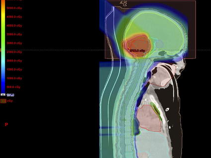 CT image of radiation plan for child with medulloblastoma