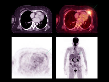 Multiple PET-CT scan images identifying a tumor recurrence in a person with lung cancer.