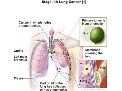 new research about lung cancer