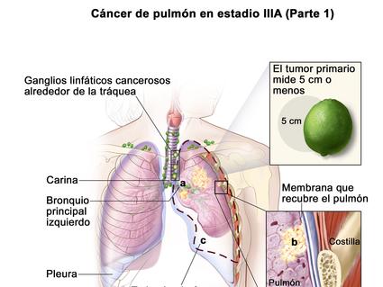 En la imagen se observan un tumor primario que mide 5 cm o menos en el pulmón izquierdo y ganglios linfáticos cancerosos alrededor de la tráquea. También se observa que el cáncer se diseminó al bronquio principal izquierdo y a la membrana que recubre el pulmón.