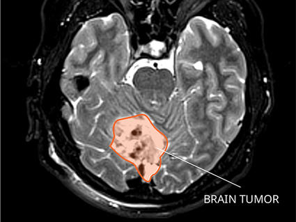 MRI of a medulloblastoma in the brain.