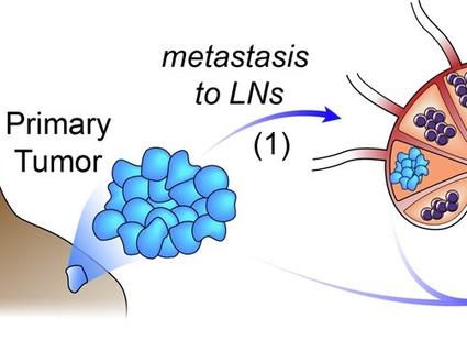 Graphic depicting tumor cells leaving the primary tumor and entering a lymph node. Immune cells leave the lymph node and enter the lungs and liver.