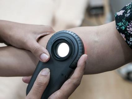 La mano de un médico usando un dermatoscopio para observar un lunar.