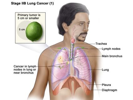 An anatomic illustration of stage 2b nonsmall cell lung cancer