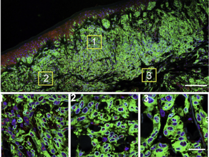 A microscopic image of melanoma cells, highlighting the androgen receptor in cell nuclei