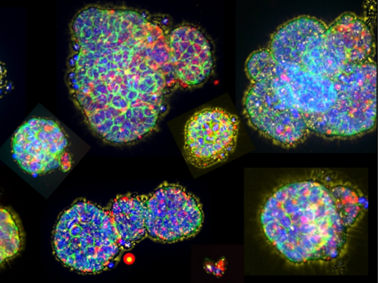 Immunofluorescence images of micro-organospheres created from a human lung tumor.