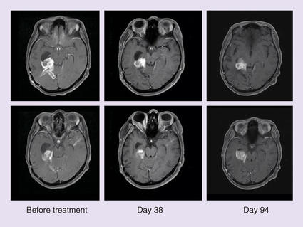 MRI scans of BRAF-positive brain tumors after dabrafenib and trametinib treatment.