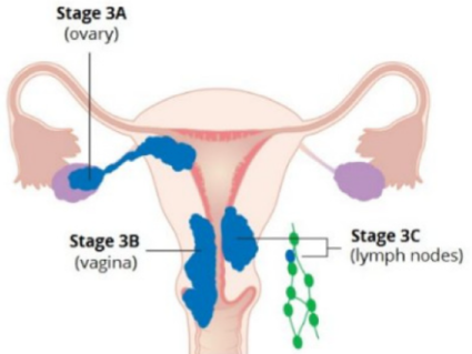 Anatomic illustration of stage 3a, 3b, and 3c endometrial cancer 