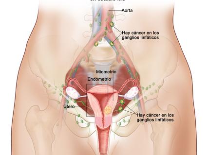 El dibujo muestra un cáncer de endometrio en estadio IIIC, en una sección transversal del útero, el cuello uterino, las trompas de Falopio, los ovarios y la vagina.
