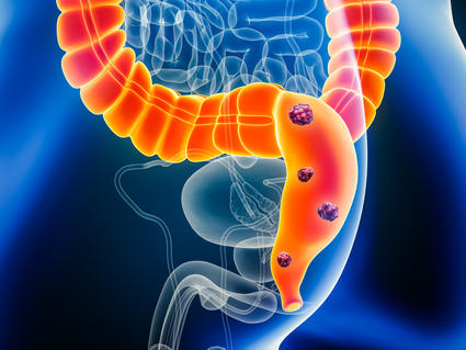 A 3-D illustration of anatomy in the lower abdomen of a male showing tumors in the colon and rectum.