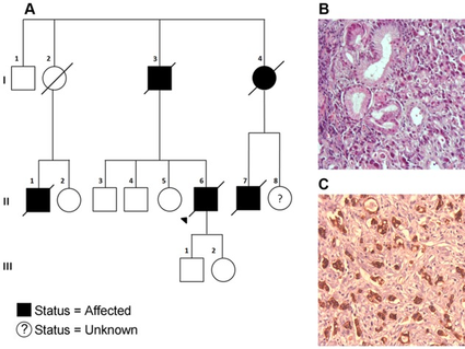 A three-part image. Part A shows a family pedigree. Parts B and C are pathology images of gastric cancer.