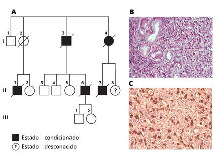 Imagen con tres partes: la parte A muestra la genealogía familiar, las partes B y C son imágenes de tejido celular con cáncer gástrico.