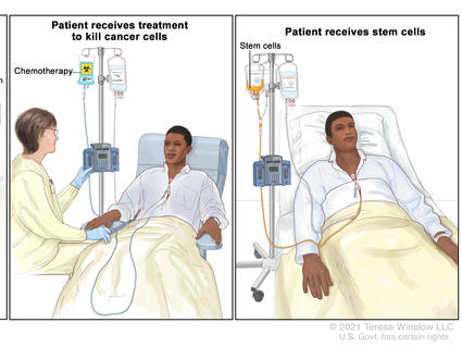 Three panels. First one shows patient hooked up to an apheresis machine. Second one show patient receiving cancer treatment. Third panel shows patient receiving their stem cells.