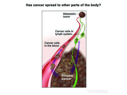 Illustration showing the spread of cancer from a tumor to other parts of the body, with labels showing cancer cells in the lymph system as well as cancer cells in a blood vessel. In the bottom part of the image, there is a large mass labeled "Primary cancer." Arrows indicate the movement of cancer cells from the primary site to the blood and lymphatic systems.