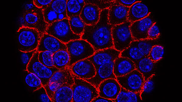 Pancreatic cancer cells growing in a sphere-shaped cluster.